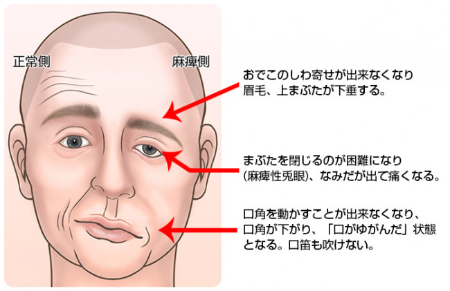 右 の 顔 が 痺れる