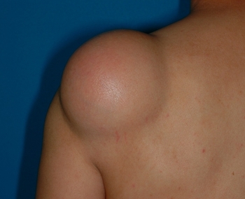 多発性脂肪腫の原因 渋谷区代々木 神子整体院